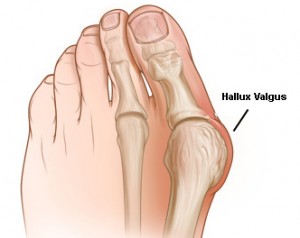 image result for hallux valgus