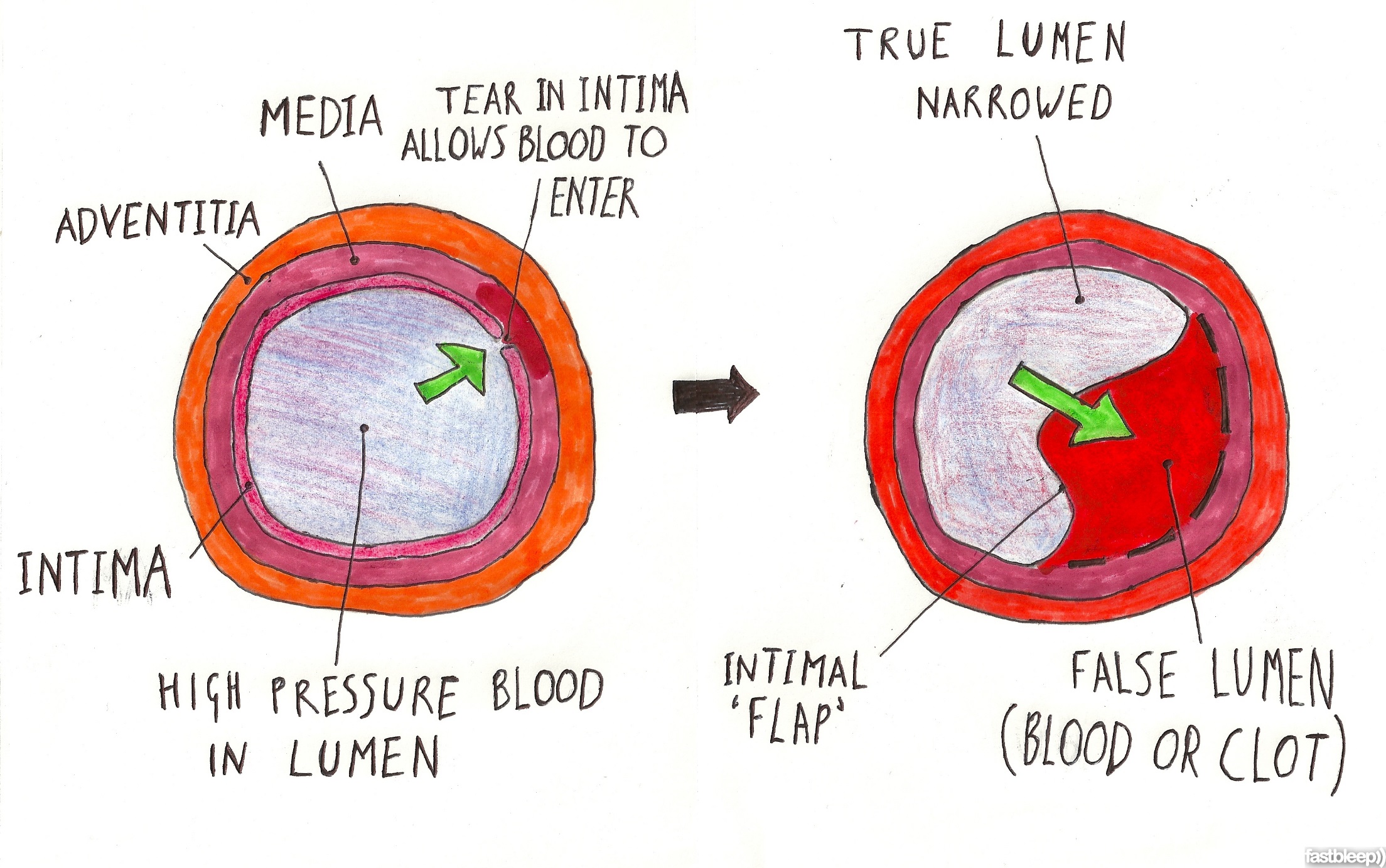 em-basic-aortic-dissection