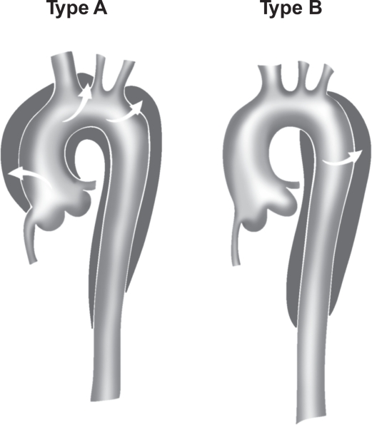 http://www.cedars-sinai.edu/patients/programs-and-services/heart-institute/centers-and-programs/aortic-program/images/stanfordclassification.jpg