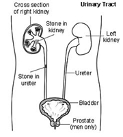 http://www.infodokterku.com/images/stories/kidney%20stonepicture.jpg