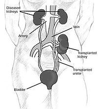 http://www.infodokterku.com/images/stories/http-titikdua-dobelgaring-en.wikipedia.org-garing-wiki-dot-kidney_transplantation.jpg