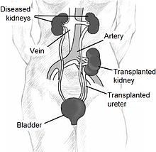 http://upload.wikimedia.org/wikipedia/commons/thumb/9/98/kidtransplant.jpg/220px-kidtransplant.jpg