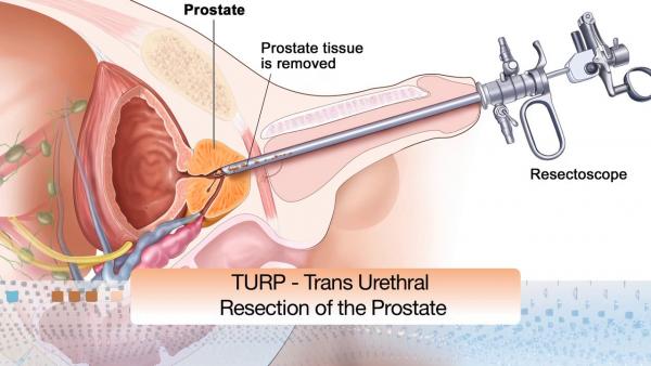 http://www.urologygroupvirginia.com/assets/newfolder/_resampled/resizedimage600338-turp.jpg