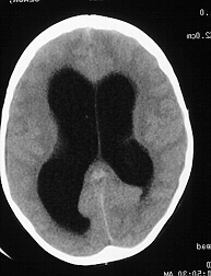 m:\2015 situasiyon tests serificasiya\pics for exanination\hydrocephalus_ct.jpg