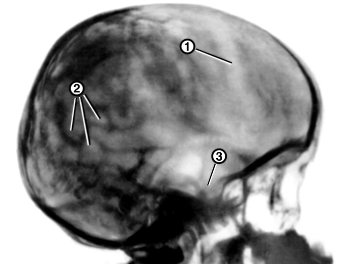 m:\2015 situasiyon tests serificasiya\pics for exanination\hydrocephalus_ct.jpg