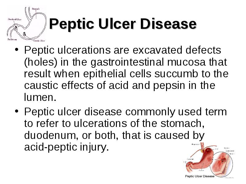 Peptic Ulcer Disease. Peptic Ulcer Disease