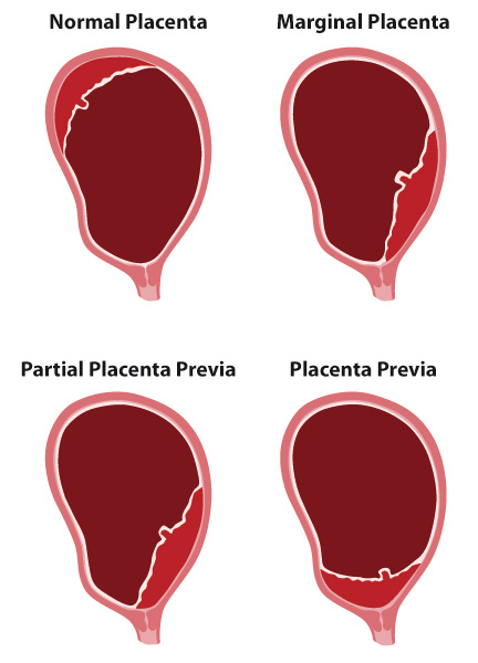 placenta_previa