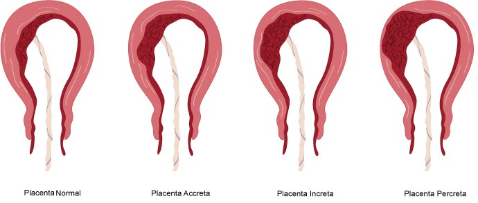 placenta+accreta+web
