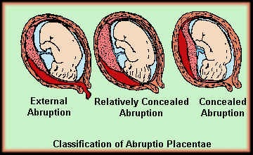 placentaabruptionclassification