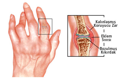 http://www.volkanverdi.com/wp-content/uploads/1rheumatoidarthritis.jpg