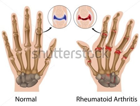 http://images.clipartlogo.com/files/ss/original/904/90428197/rheumatoid-arthritis-of-finger.jpg