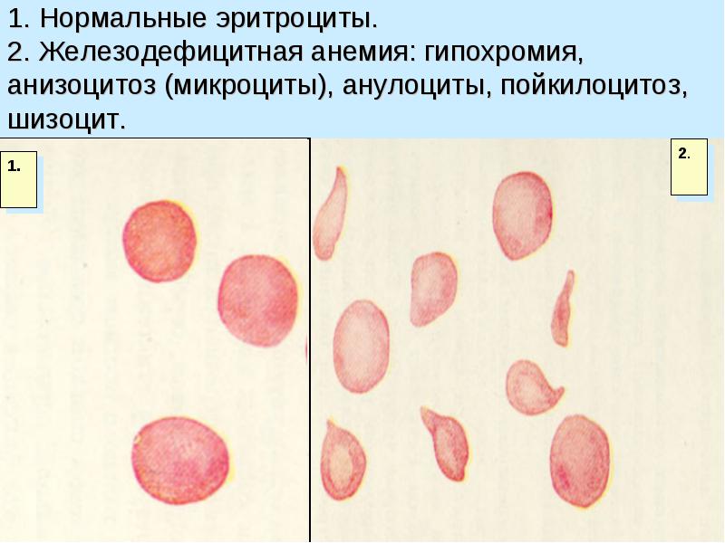 Анемии классификация патогенез лечение