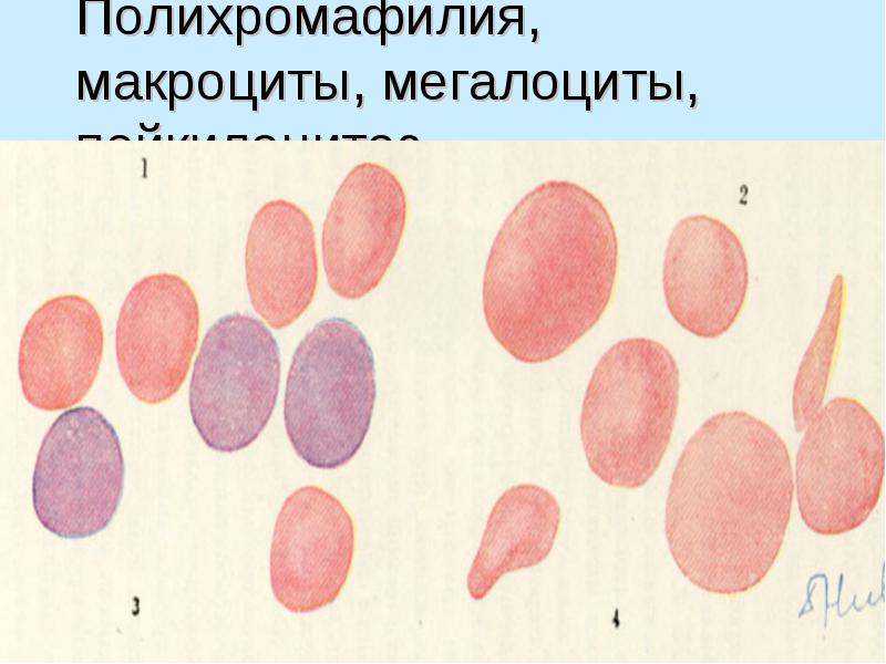 Анемии классификация патогенез лечение