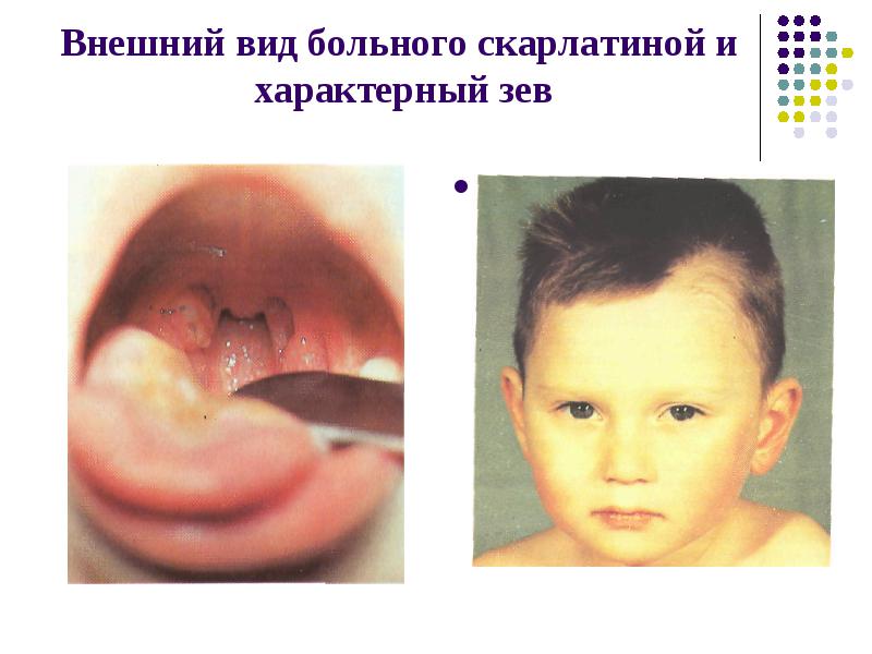 Скарлатина корь краснуха у детей лечение