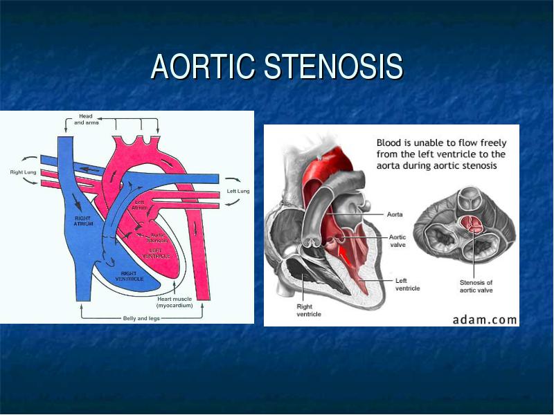 Aortic stenosis by epifani d. Armedilla