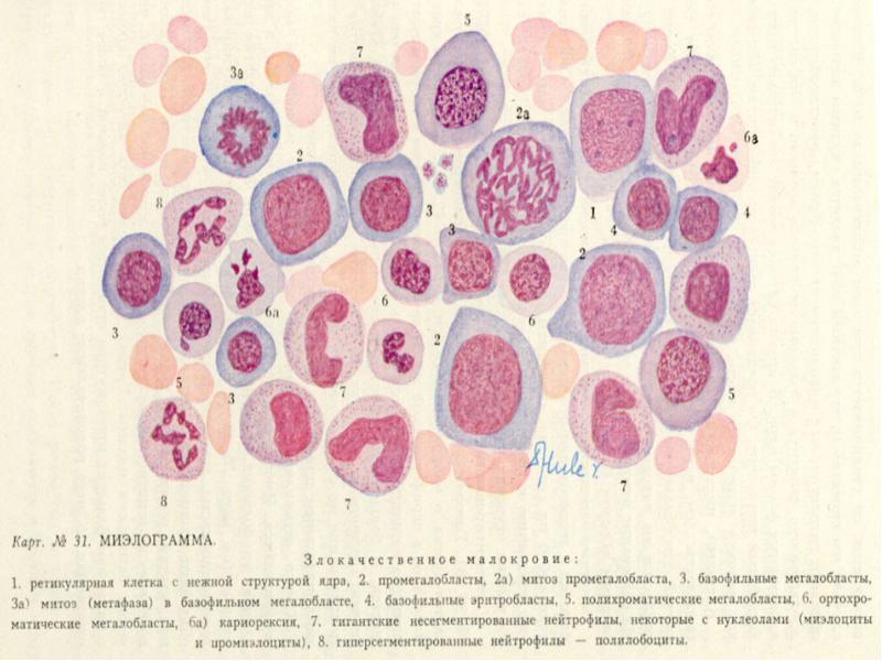 Пернициозная анемия