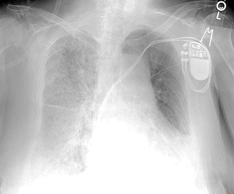 chest x-ray