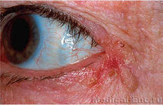 a blepharitis befolyásolja a látást)