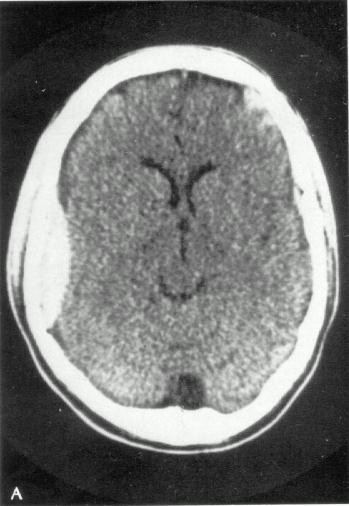 d:\viktoro\neuroscience\trh. head trauma\00. pictures\epidhem2 (ct).jpg