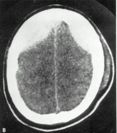 d:\viktoro\neuroscience\trh. head trauma\00. pictures\epidhem (ct).jpg