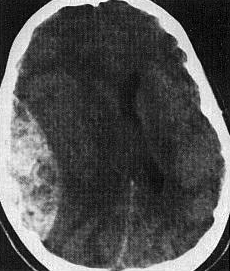 d:\viktoro\neuroscience\trh. head trauma\00. pictures\epidhem7 (ct).jpg