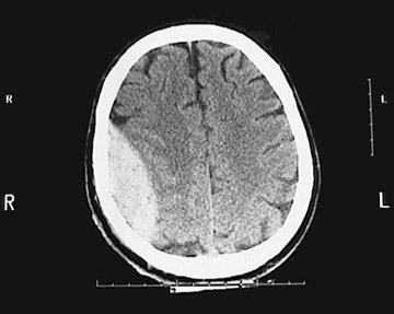 d:\viktoro\neuroscience\trh. head trauma\00. pictures\epidural hematoma (ct) 2.jpg