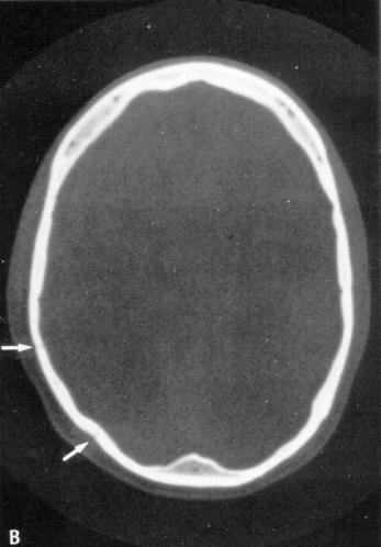 d:\viktoro\neuroscience\trh. head trauma\00. pictures\epidhem3 (ct).jpg