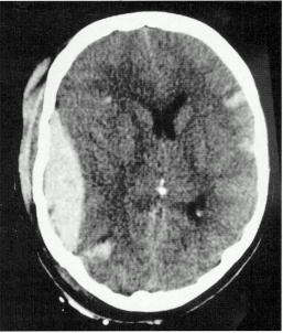 d:\viktoro\neuroscience\trh. head trauma\00. pictures\epidhem5 (ct).jpg