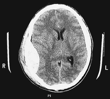 d:\viktoro\neuroscience\trh. head trauma\00. pictures\epidural hematoma (ct) 1.jpg