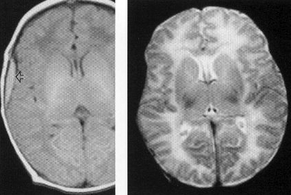 d:\viktoro\neuroscience\trh. head trauma\00. pictures\epidural hematoma (mri).jpg