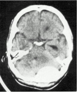 d:\viktoro\neuroscience\trh. head trauma\00. pictures\epidhem6 (ct).jpg