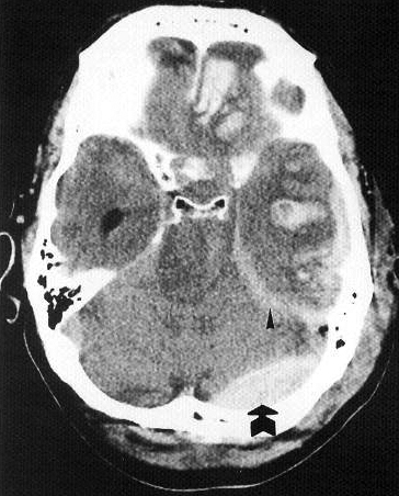 d:\viktoro\neuroscience\trh. head trauma\00. pictures\epidhem8 (ct).jpg