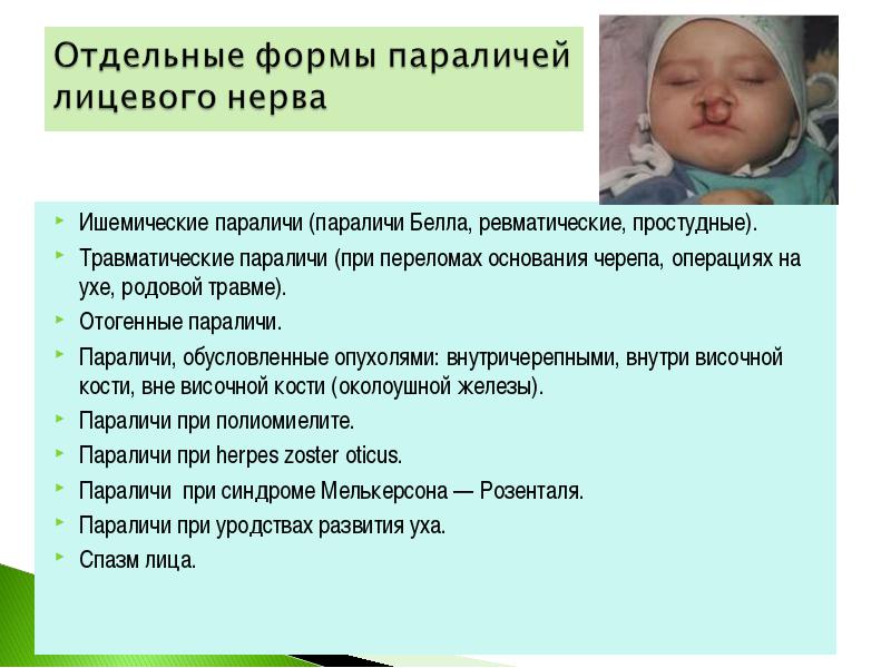 Лицевой нерв последствия. Парез лицевого нерва у новорожденного. Родовые травмы паралич лицевого нерва. Паралич лицевого нерва у новорожденного. Родовая травма парез лицевого нерва.