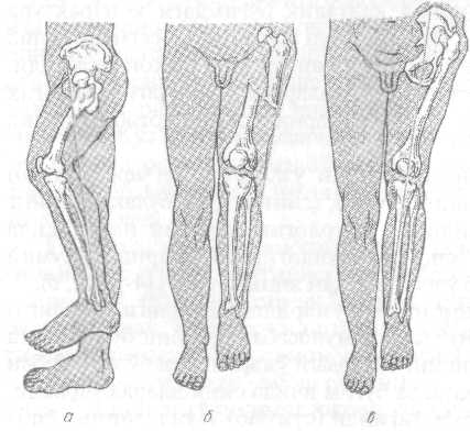 Симптом прилипшей пятки характерен. Перелом бедра и укорочение конечности. Оскольчатый перелом бедренной кости. Сгибательная контрактура коленного сустава. Укорочение конечности при переломе шейки бедра.