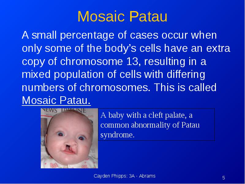 Syndrome patau Patau syndrome: