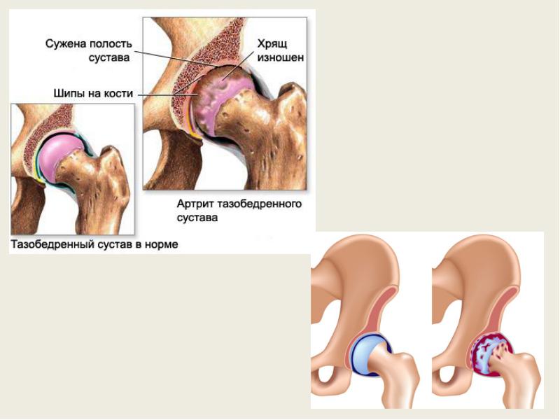 Коксартроз код. Хрящ тазобедренного сустава. Суставной хрящ бедренной кости. Суставный хрящ в тазобедренном суставе. Наращивание хряща в тазобедренном суставе.