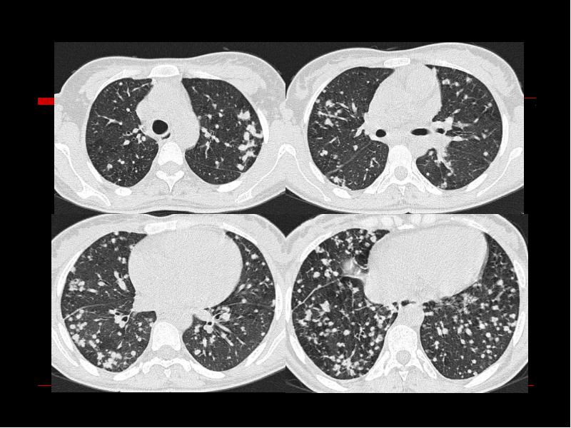 Кт картина саркоидоза легких