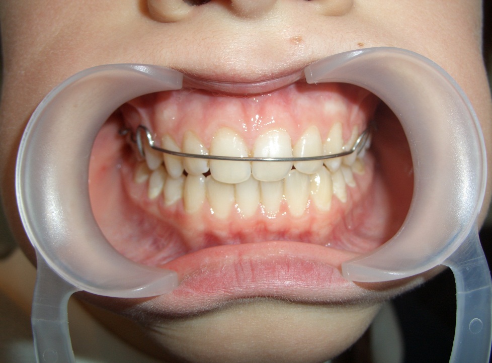 Со скольки лет можно ставить зуб. Съёмные пластины для зубов детям. Съемная зубная пластина.