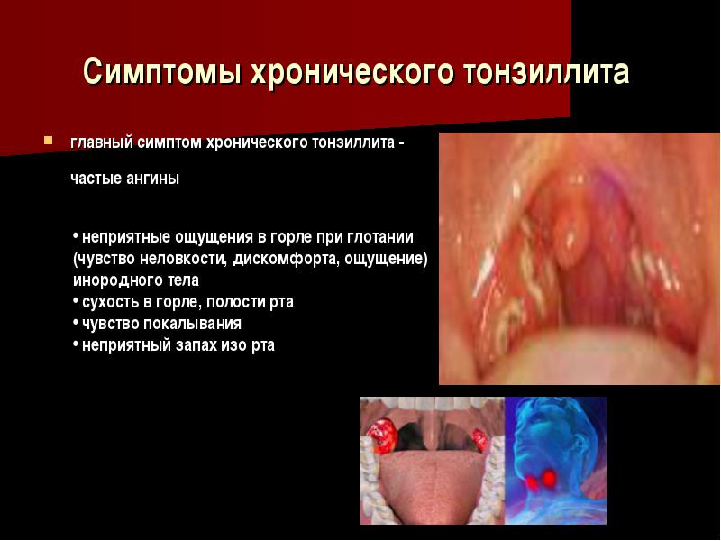 A prosztatitis tonszillitis kommunikációja)