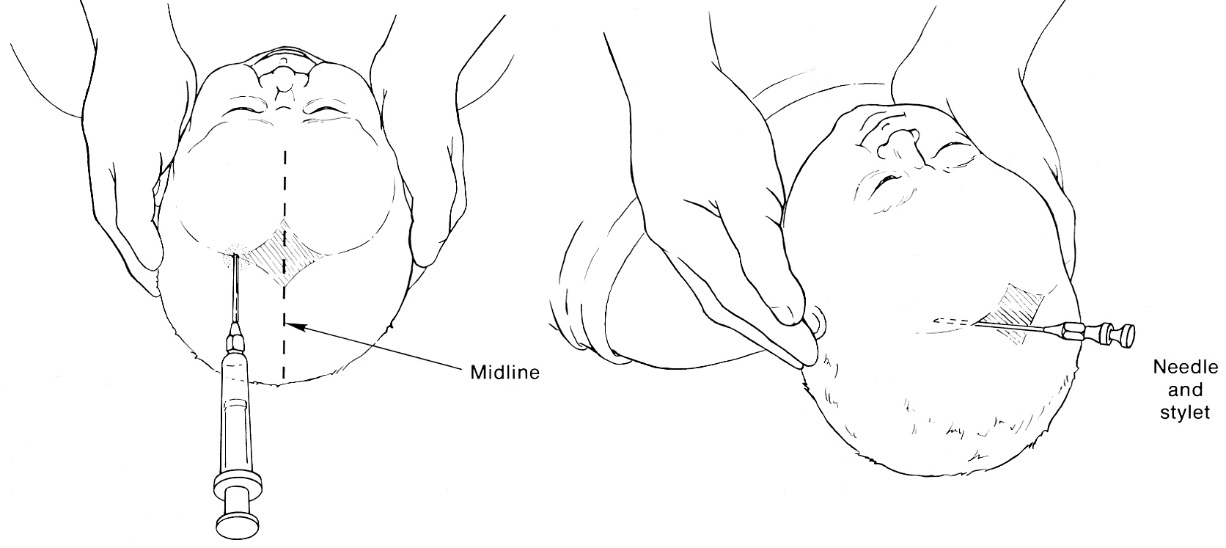 d:\viktoro\neuroscience\trh. head trauma\00. pictures\subdural aspiration (infant).jpg