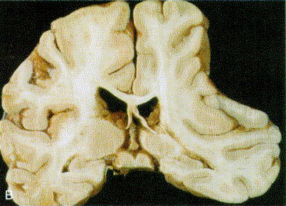 d:\viktoro\neuroscience\trh. head trauma\00. pictures\subdural hematoma (macro) 2.jpg