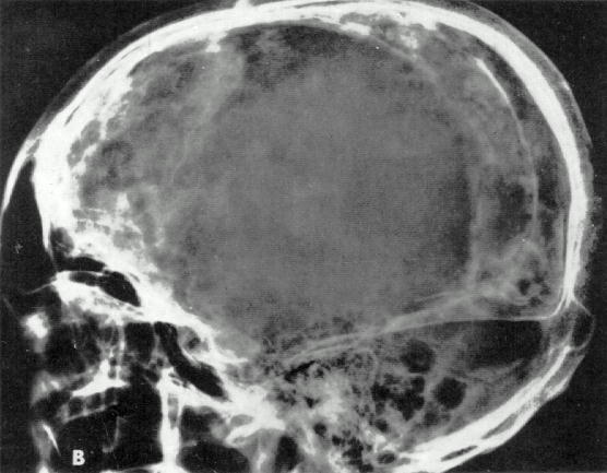 d:\viktoro\neuroscience\trh. head trauma\00. pictures\subhem2 (ro).jpg