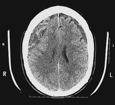 d:\viktoro\neuroscience\trh. head trauma\00. pictures\subdural hematoma (ct) 2.jpg