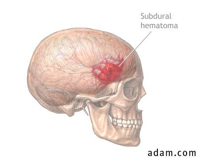 d:\viktoro\neuroscience\trh. head trauma\00. pictures\subhem (piešta).jpg