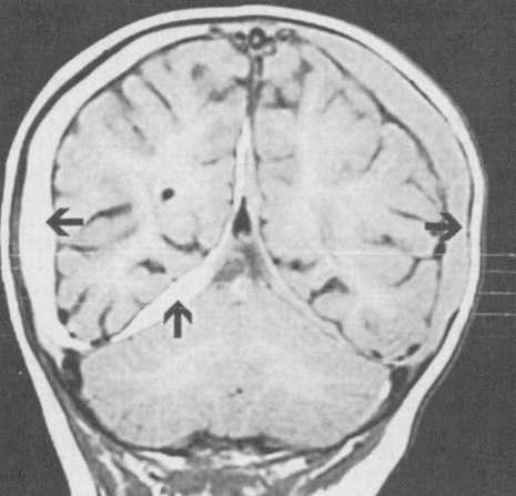 d:\viktoro\neuroscience\trh. head trauma\00. pictures\subhem4 (mri).jpg