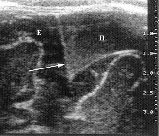 d:\viktoro\neuroscience\trh. head trauma\00. pictures\acute subdural haematoma (ultrasound).jpg
