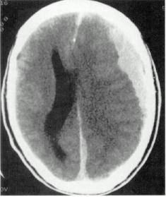 d:\viktoro\neuroscience\trh. head trauma\00. pictures\subhem3 (ct).jpg