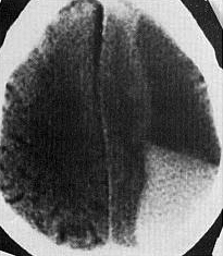 d:\viktoro\neuroscience\trh. head trauma\00. pictures\acute sdh (ct).jpg