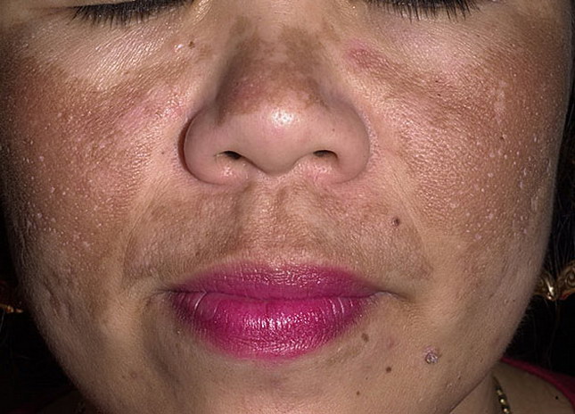 d:\melasma-40-a-foto.jpg