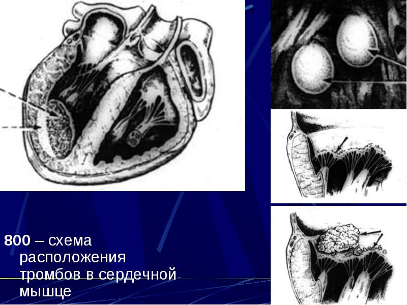 Сердечный тромбоз. Тромбоз в полостях сердца. Шаровидные тромбы в полости сердца. Наличие тромба в полостях сердца..